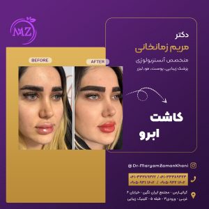 کاشت ابرو در اهواز