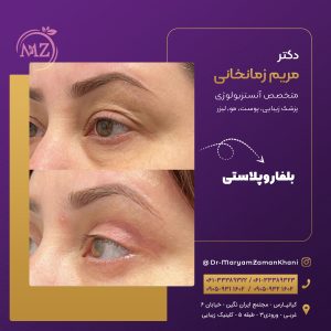 بلفاروپلاستی