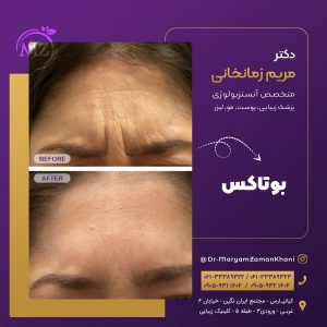 تزریق بوتاکس