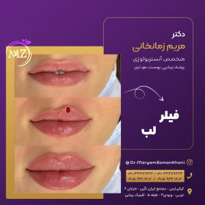 تزریق فیلر لب