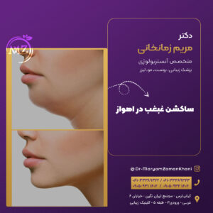 ساکشن غبغب در اهواز